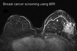 Breast Cancer Screening Using MRI