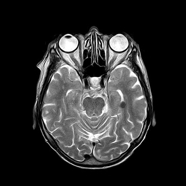 Head MRI