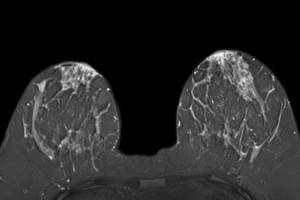 Breast Cancer Screening Using MRI